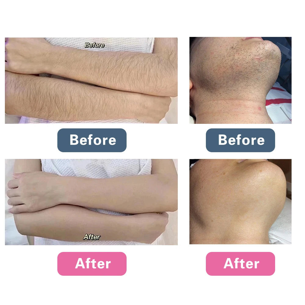 2026 Intelligent TUV ISO CE Diode Laser Face Lift  Ice Platinum Titanium Hair Removal Price/lightsheer Diode Laser 755 808 1064
